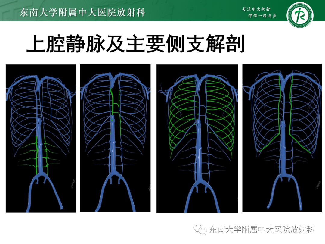 影像PPT - 【PPT】上腔静脉综合征MDCT表现-13 影像PPT - 【PPT】上腔静脉综合征MDCT表现-13