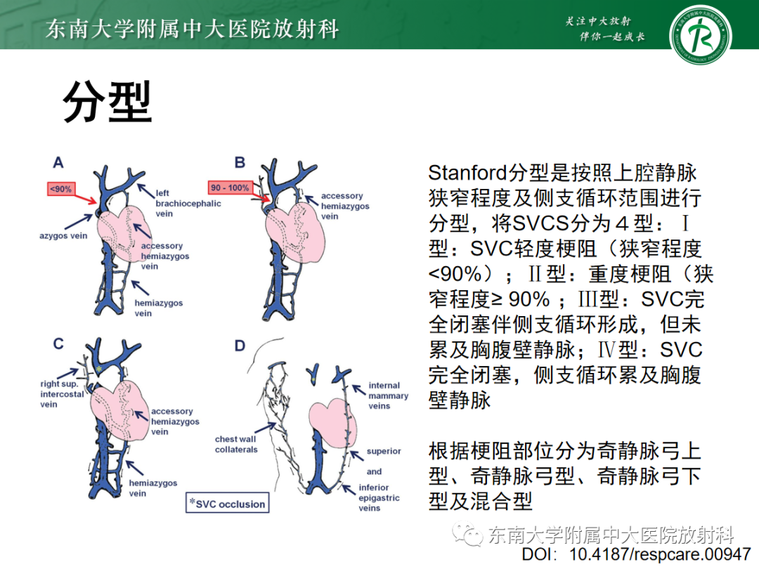 影像PPT - 【PPT】上腔静脉综合征MDCT表现-16 影像PPT - 【PPT】上腔静脉综合征MDCT表现-16