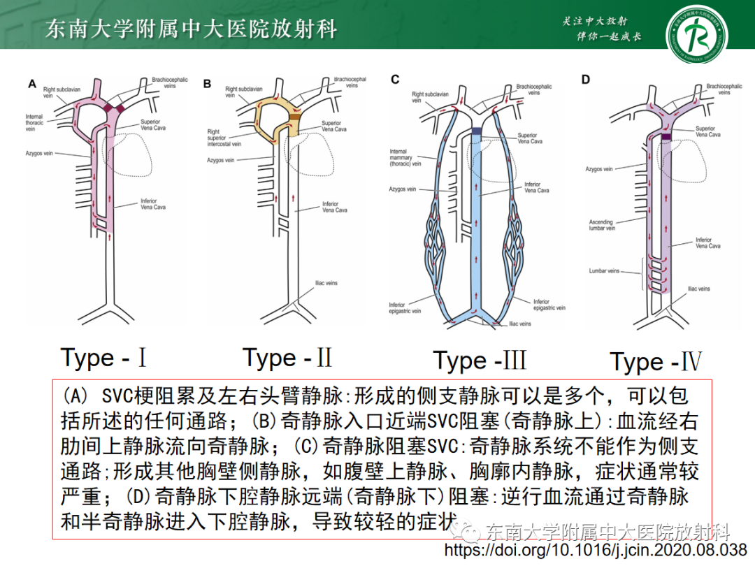 影像PPT - 【PPT】上腔静脉综合征MDCT表现-19 影像PPT - 【PPT】上腔静脉综合征MDCT表现-19