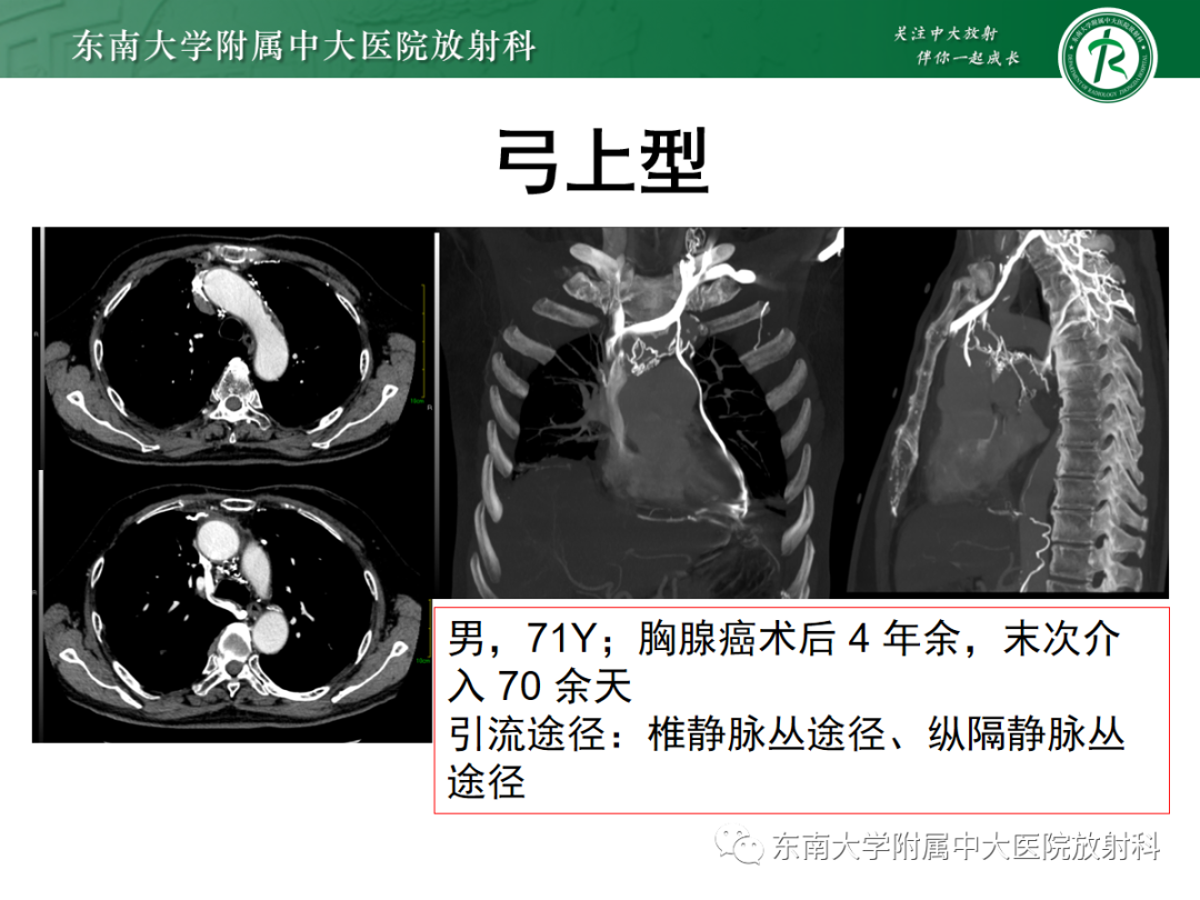 影像PPT - 【PPT】上腔静脉综合征MDCT表现-20 影像PPT - 【PPT】上腔静脉综合征MDCT表现-20