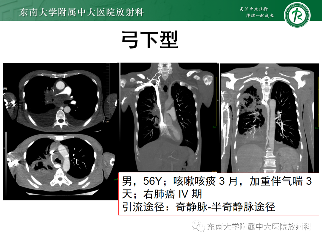 影像PPT - 【PPT】上腔静脉综合征MDCT表现-21 影像PPT - 【PPT】上腔静脉综合征MDCT表现-21