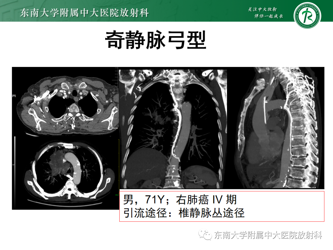 影像PPT - 【PPT】上腔静脉综合征MDCT表现-22 影像PPT - 【PPT】上腔静脉综合征MDCT表现-22