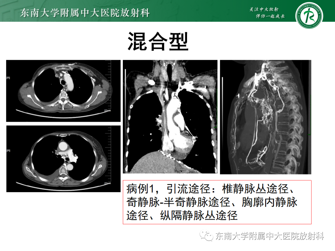 影像PPT - 【PPT】上腔静脉综合征MDCT表现-23 影像PPT - 【PPT】上腔静脉综合征MDCT表现-23