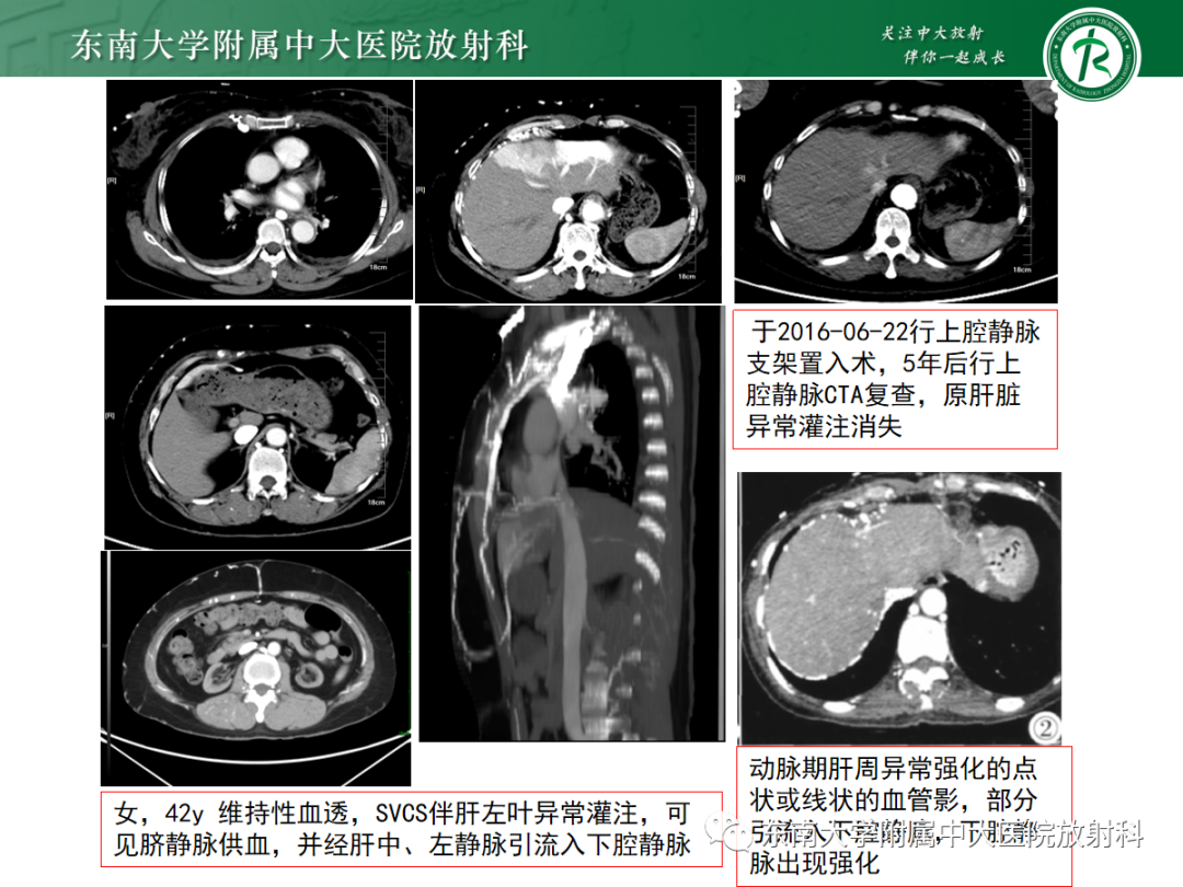 影像PPT - 【PPT】上腔静脉综合征MDCT表现-28 影像PPT - 【PPT】上腔静脉综合征MDCT表现-28