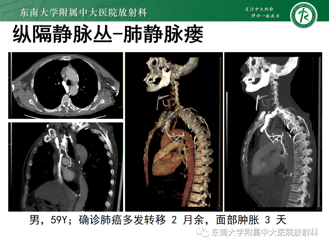 影像PPT - 【PPT】上腔静脉综合征MDCT表现-30 影像PPT - 【PPT】上腔静脉综合征MDCT表现-30