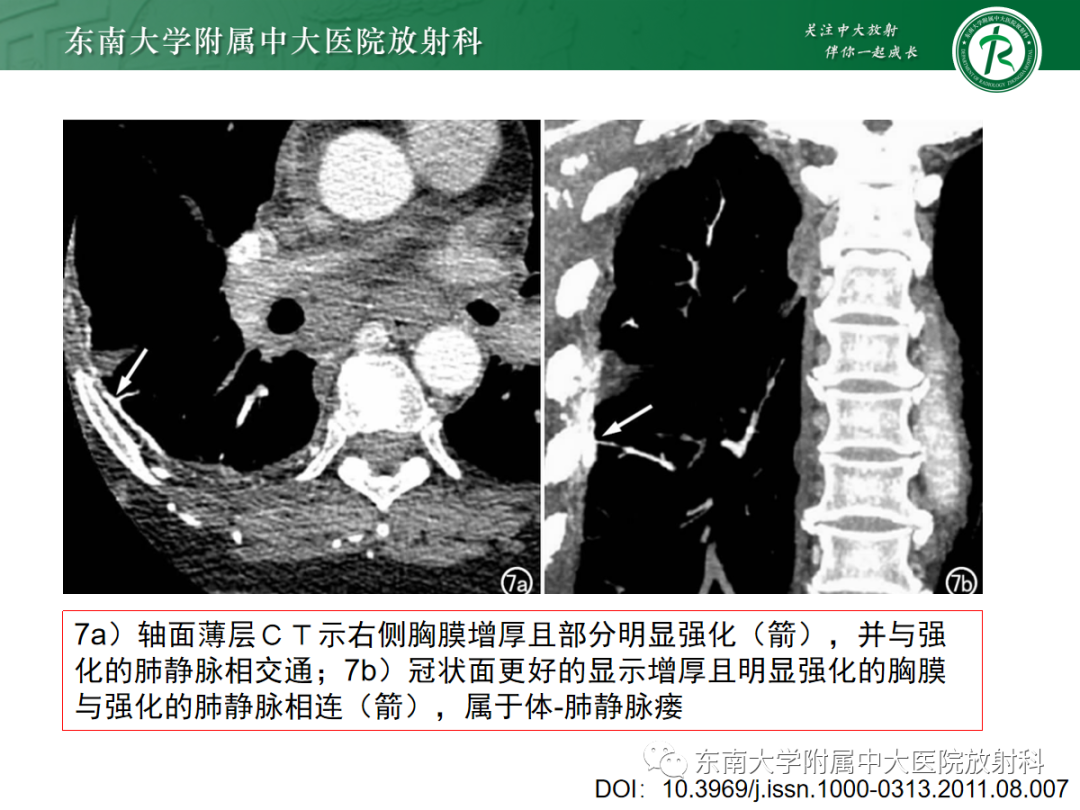 影像PPT - 【PPT】上腔静脉综合征MDCT表现-31 影像PPT - 【PPT】上腔静脉综合征MDCT表现-31