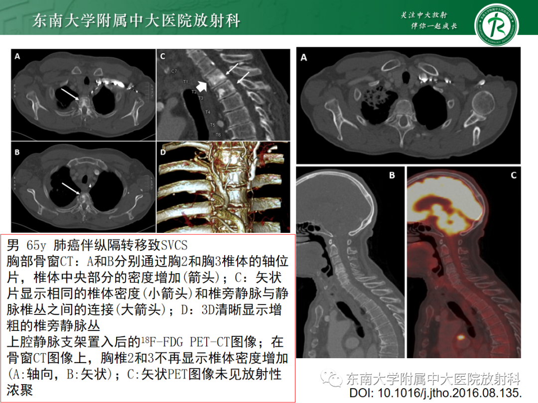 影像PPT - 【PPT】上腔静脉综合征MDCT表现-33 影像PPT - 【PPT】上腔静脉综合征MDCT表现-33