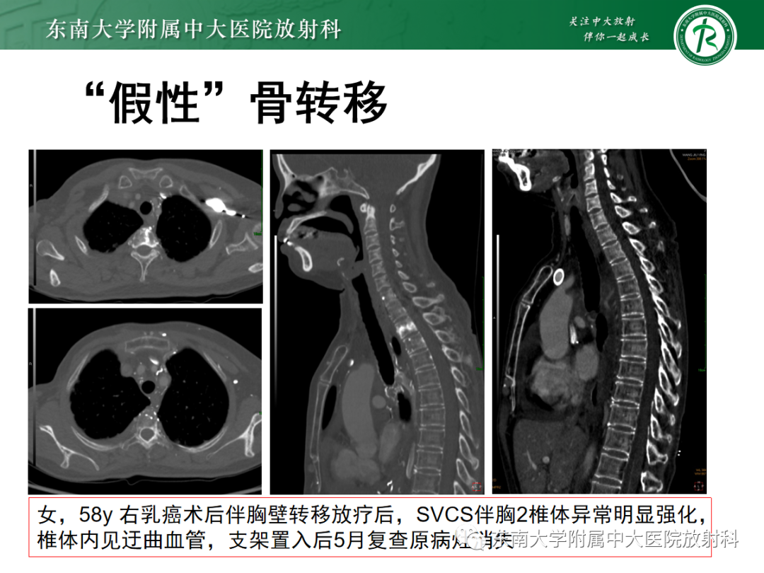 影像PPT - 【PPT】上腔静脉综合征MDCT表现-34 影像PPT - 【PPT】上腔静脉综合征MDCT表现-34
