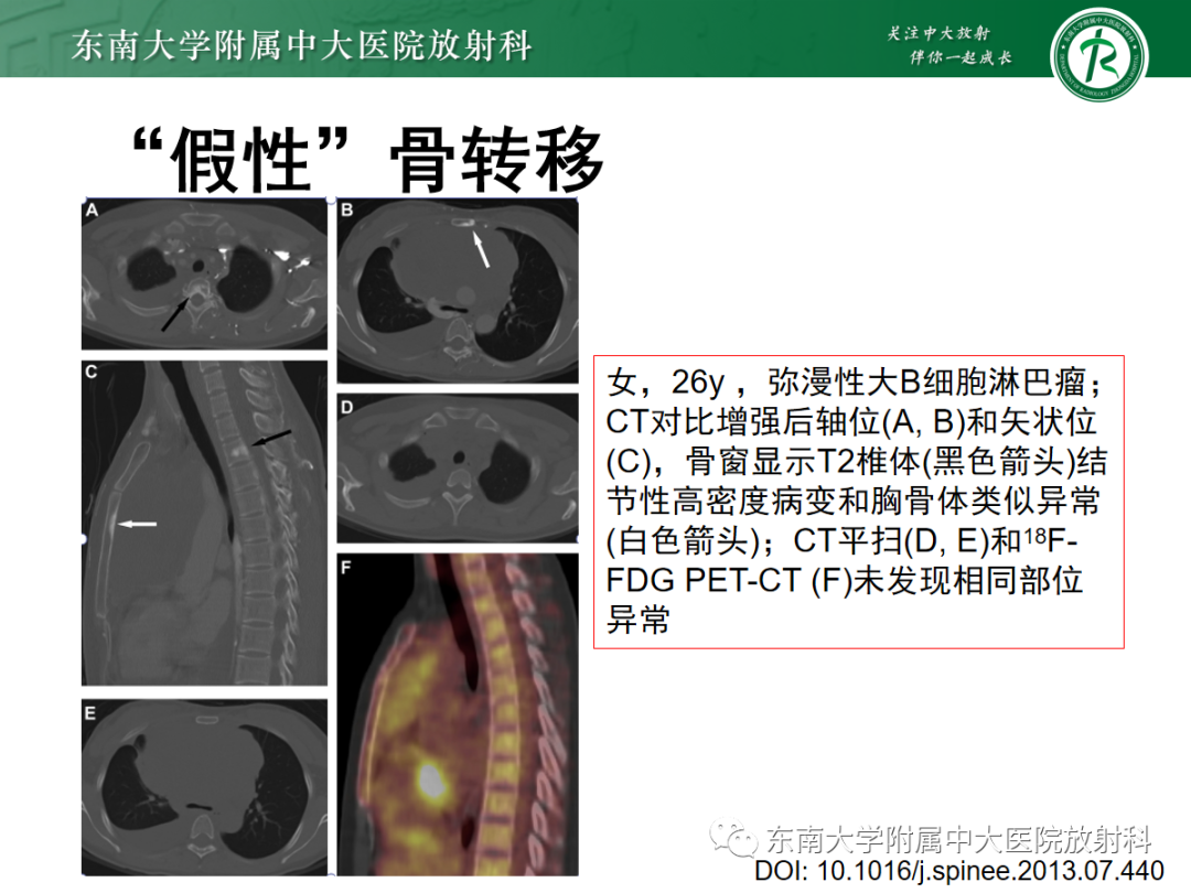 影像PPT - 【PPT】上腔静脉综合征MDCT表现-35 影像PPT - 【PPT】上腔静脉综合征MDCT表现-35