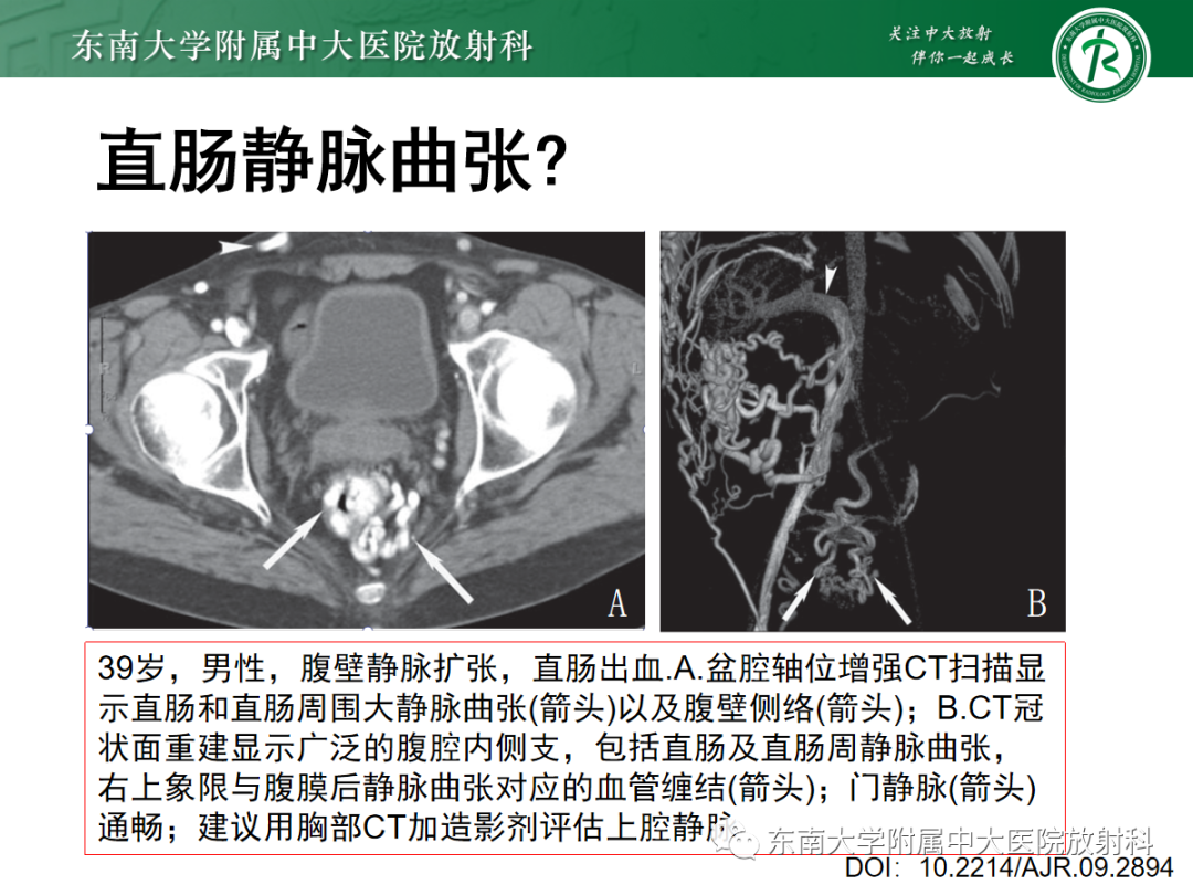 影像PPT - 【PPT】上腔静脉综合征MDCT表现-36 影像PPT - 【PPT】上腔静脉综合征MDCT表现-36
