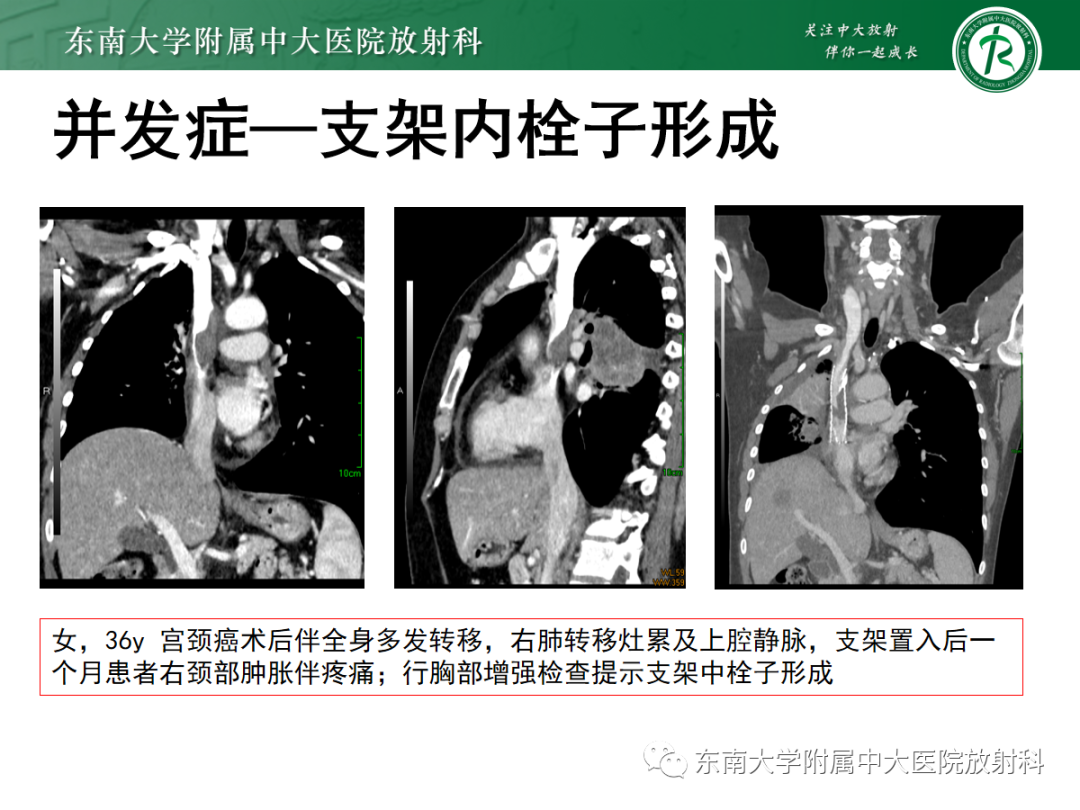 影像PPT - 【PPT】上腔静脉综合征MDCT表现-38 影像PPT - 【PPT】上腔静脉综合征MDCT表现-38