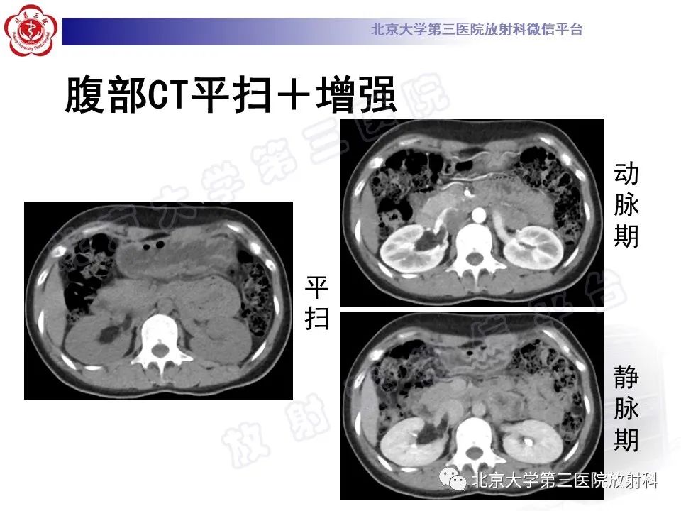 影像PPT - 【PPT】肾血管平滑肌脂肪瘤伴下腔静脉瘤栓-5