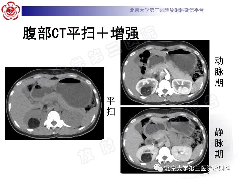 影像PPT - 【PPT】肾血管平滑肌脂肪瘤伴下腔静脉瘤栓-4