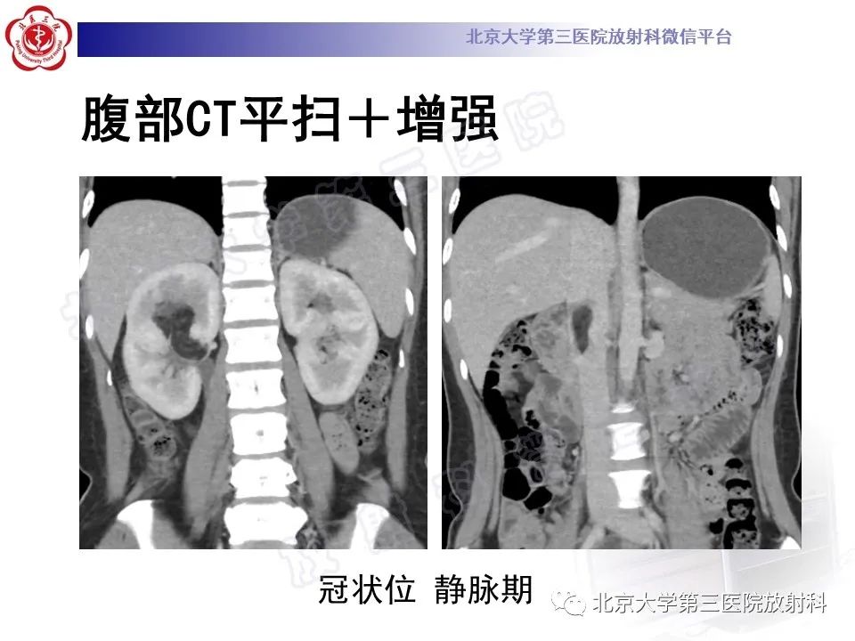 影像PPT - 【PPT】肾血管平滑肌脂肪瘤伴下腔静脉瘤栓-6