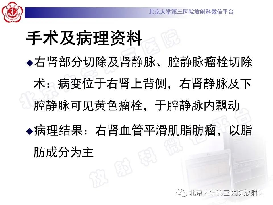 影像PPT - 【PPT】肾血管平滑肌脂肪瘤伴下腔静脉瘤栓-8