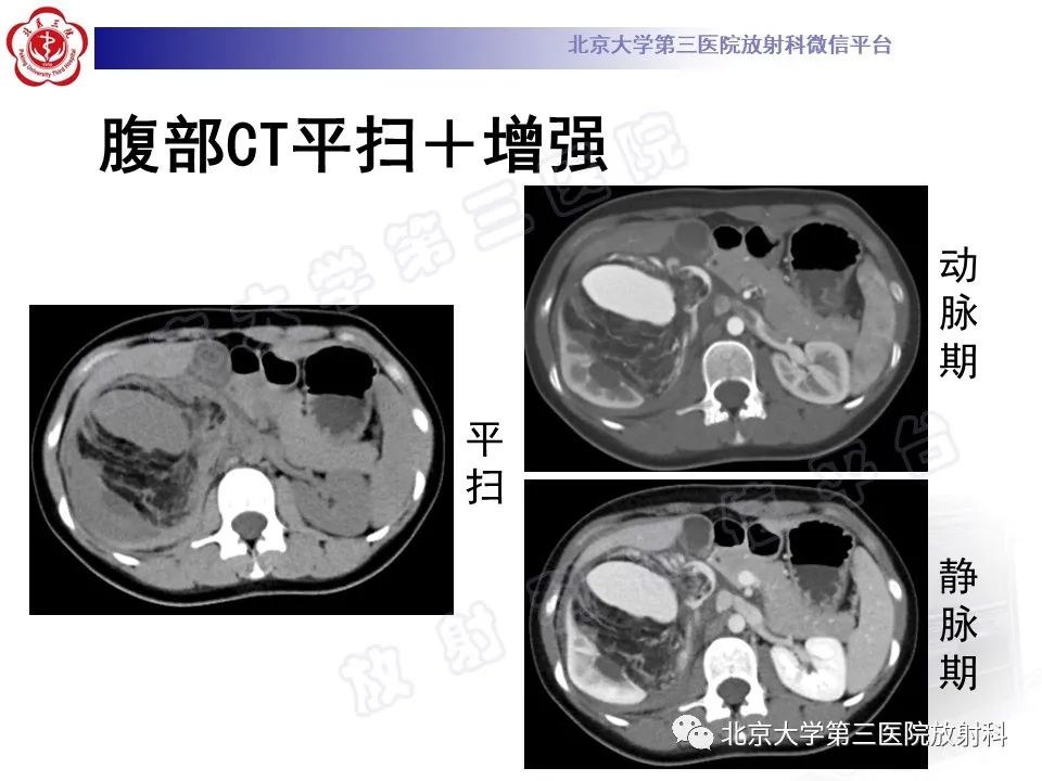 影像PPT - 【PPT】肾血管平滑肌脂肪瘤伴下腔静脉瘤栓-11
