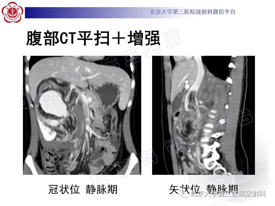 影像PPT - 【PPT】肾血管平滑肌脂肪瘤伴下腔静脉瘤栓-12