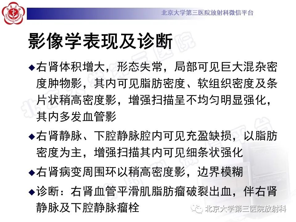 影像PPT - 【PPT】肾血管平滑肌脂肪瘤伴下腔静脉瘤栓-13