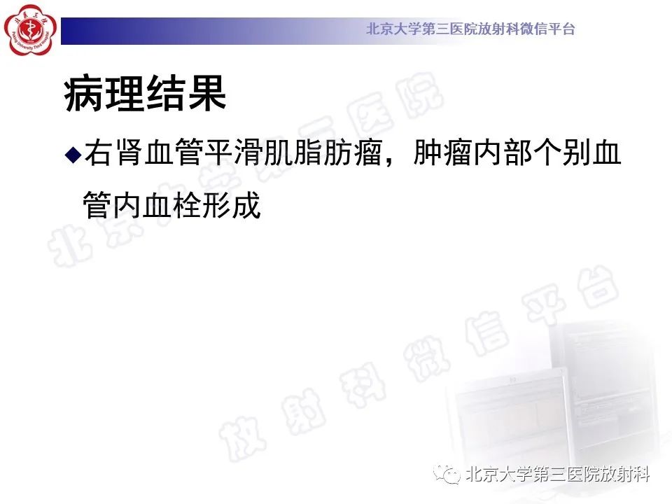 影像PPT - 【PPT】肾血管平滑肌脂肪瘤伴下腔静脉瘤栓-14