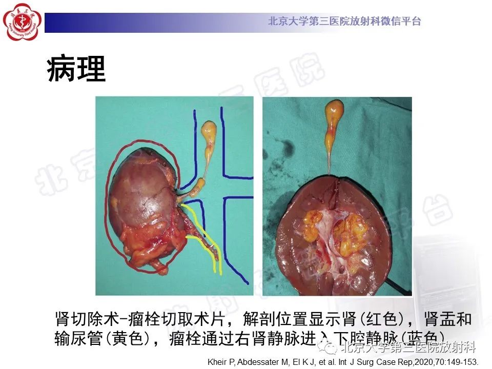 影像PPT - 【PPT】肾血管平滑肌脂肪瘤伴下腔静脉瘤栓-18