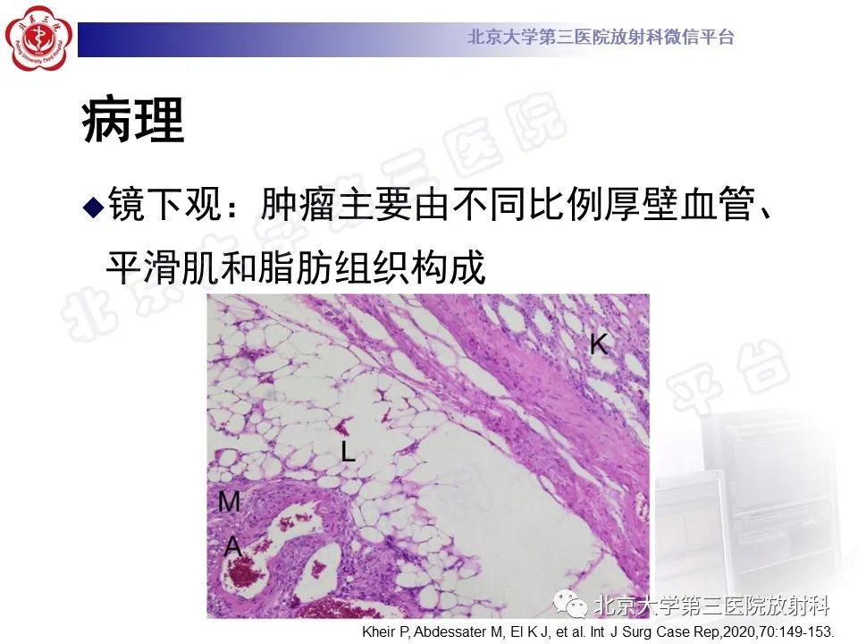 影像PPT - 【PPT】肾血管平滑肌脂肪瘤伴下腔静脉瘤栓-19