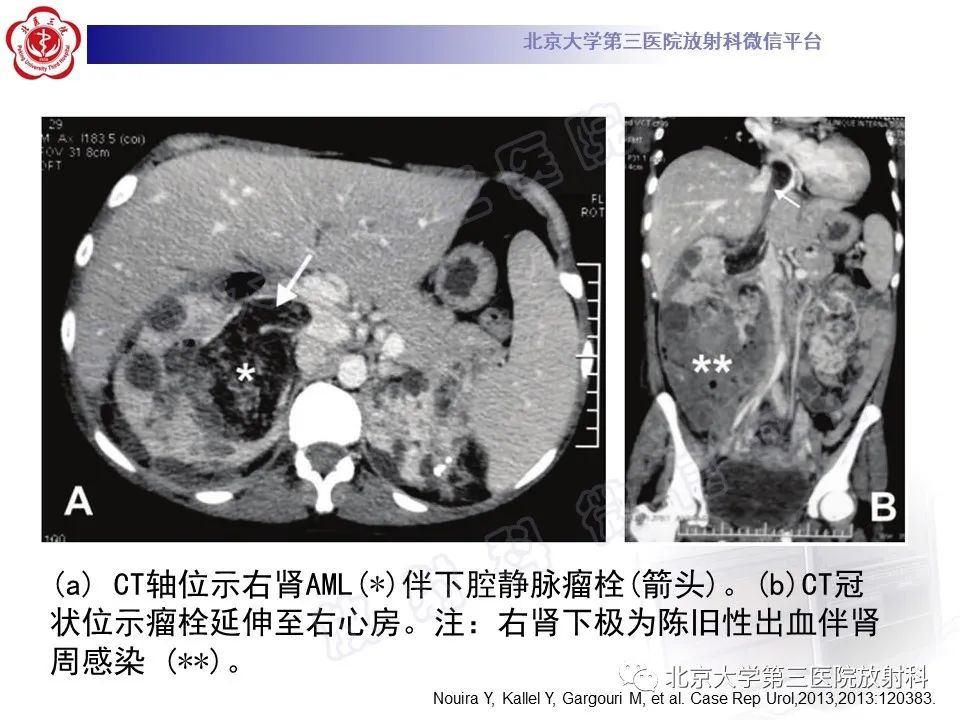 影像PPT - 【PPT】肾血管平滑肌脂肪瘤伴下腔静脉瘤栓-22