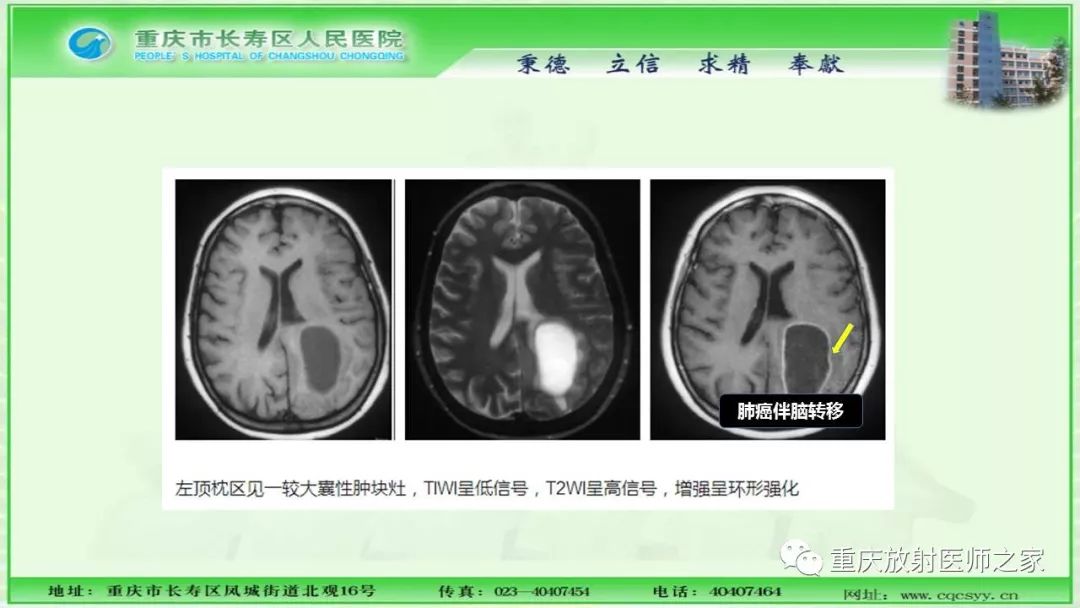 影像PPT - 【PPT】脑实质内囊性病变的MR诊断-11