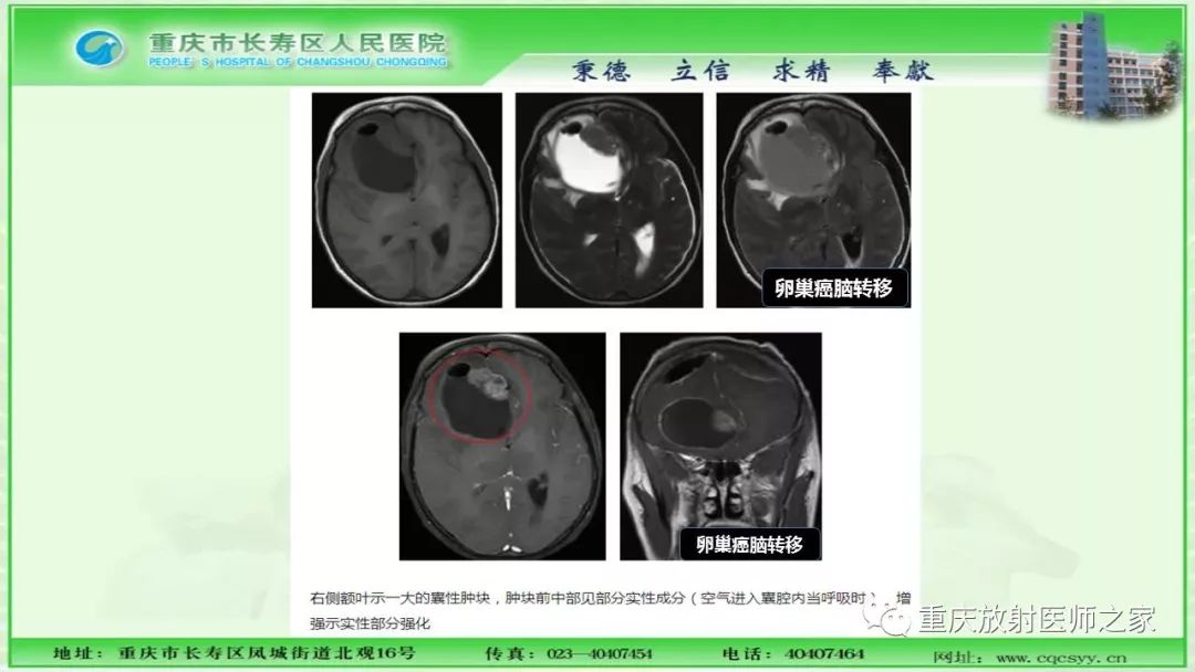 影像PPT - 【PPT】脑实质内囊性病变的MR诊断-12
