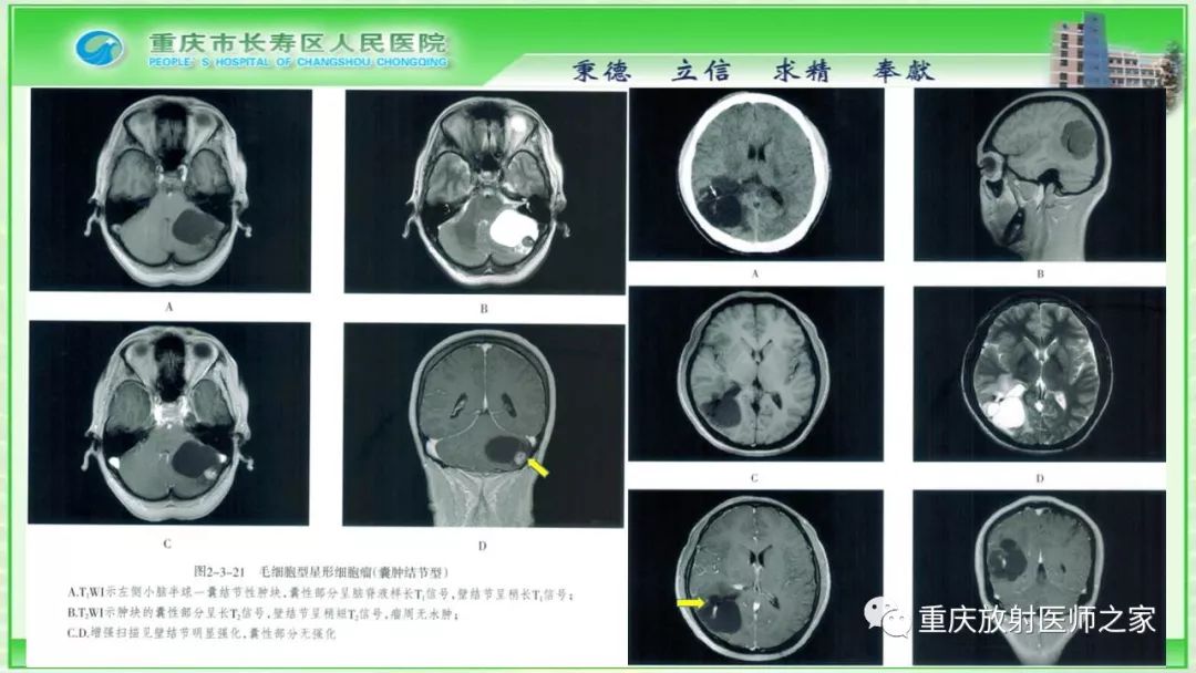 影像PPT - 【PPT】脑实质内囊性病变的MR诊断-16