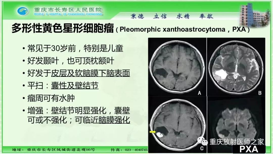 影像PPT - 【PPT】脑实质内囊性病变的MR诊断-17