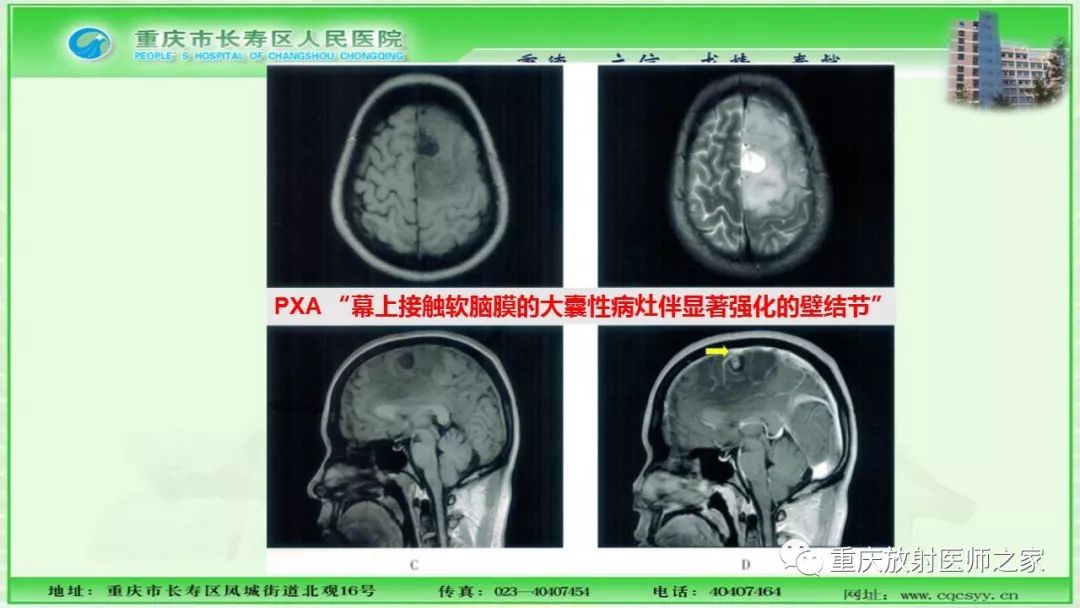 影像PPT - 【PPT】脑实质内囊性病变的MR诊断-18