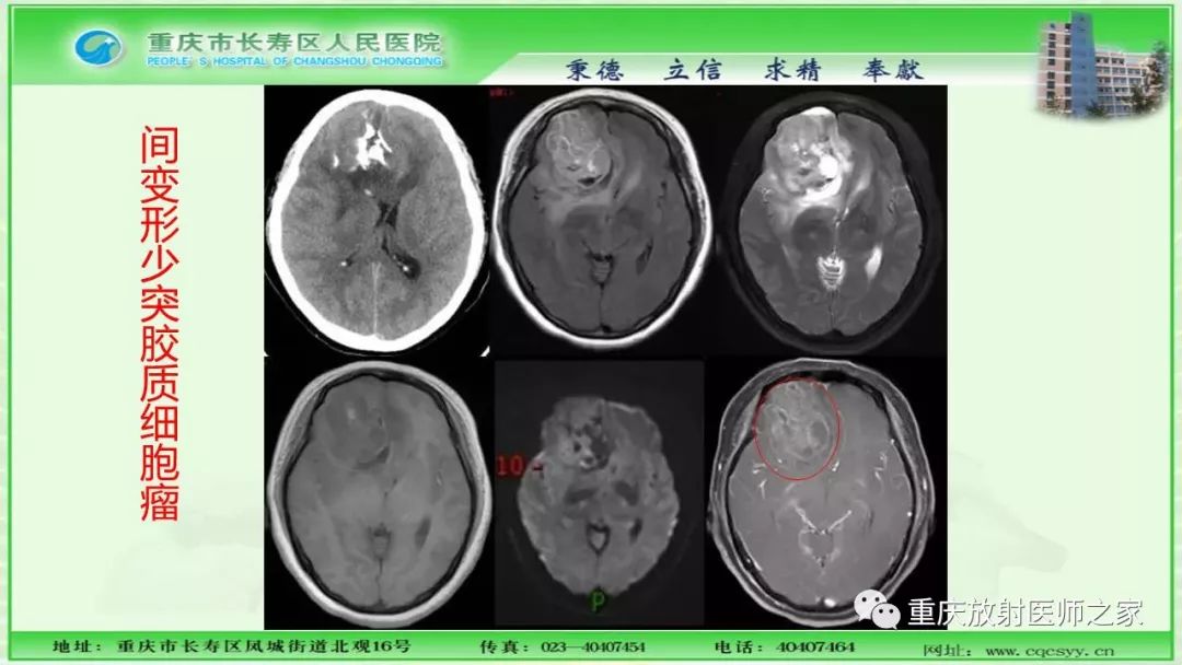 影像PPT - 【PPT】脑实质内囊性病变的MR诊断-20