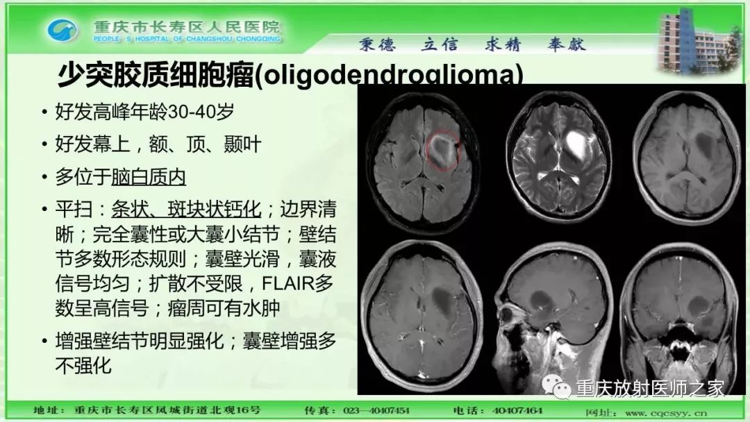 影像PPT - 【PPT】脑实质内囊性病变的MR诊断-19
