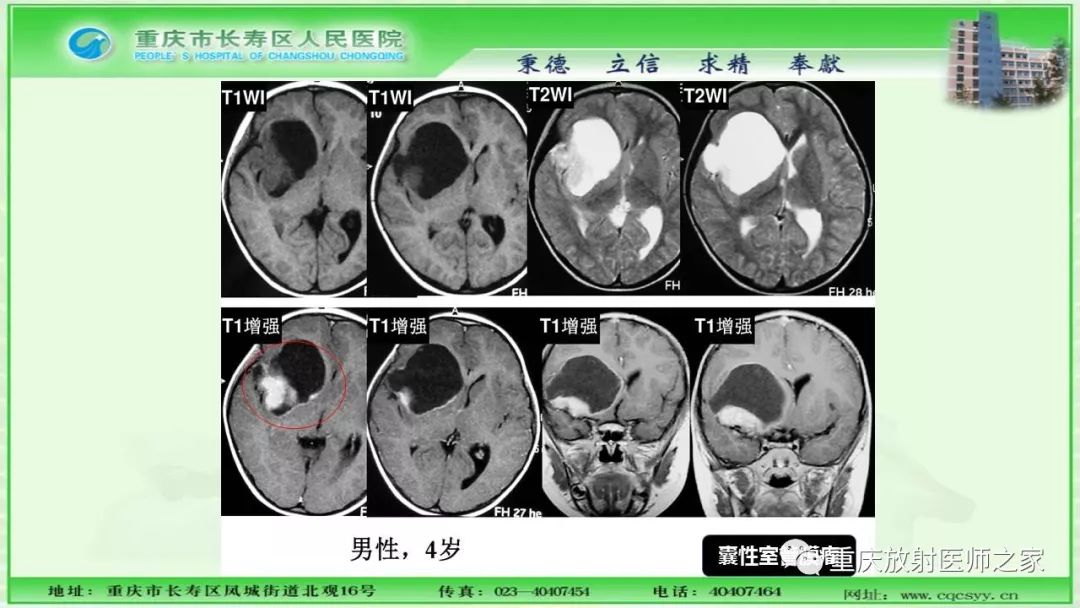 影像PPT - 【PPT】脑实质内囊性病变的MR诊断-22