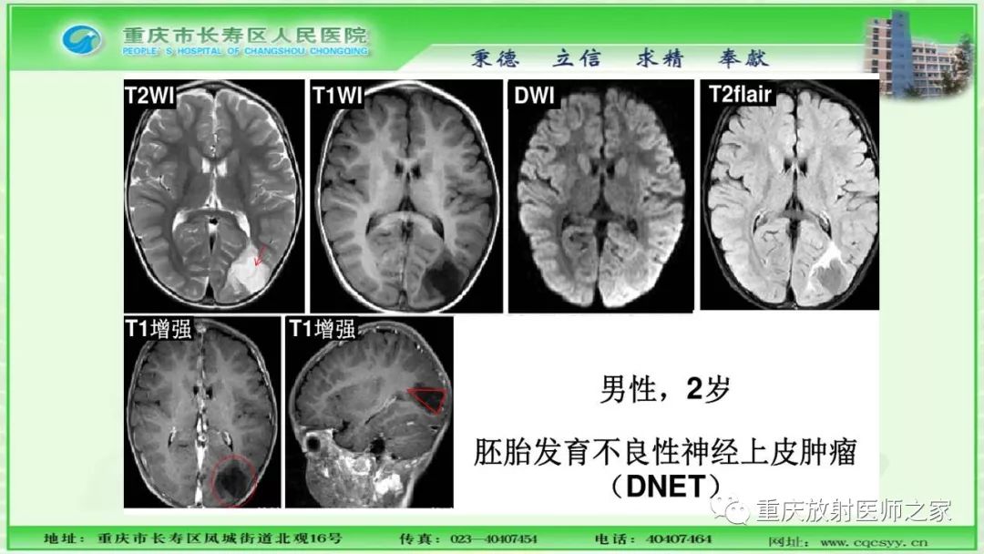 影像PPT - 【PPT】脑实质内囊性病变的MR诊断-25