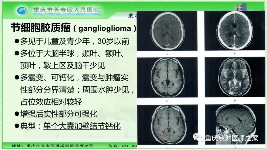 影像PPT - 【PPT】脑实质内囊性病变的MR诊断-27