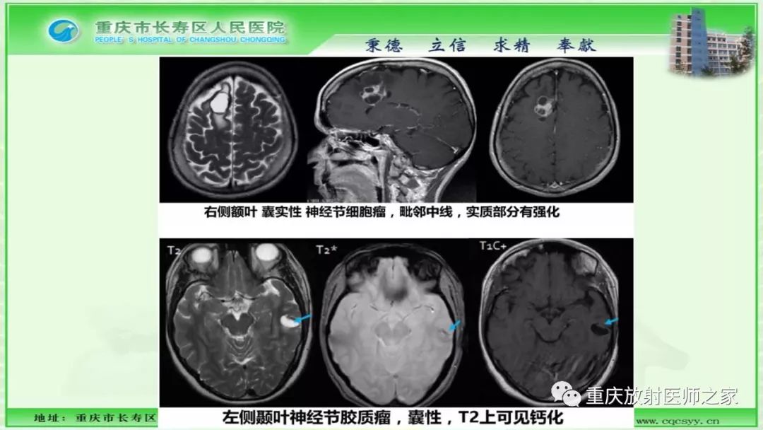 影像PPT - 【PPT】脑实质内囊性病变的MR诊断-28