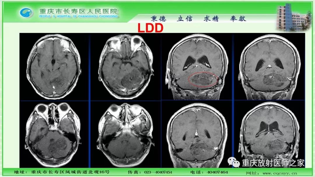 影像PPT - 【PPT】脑实质内囊性病变的MR诊断-30