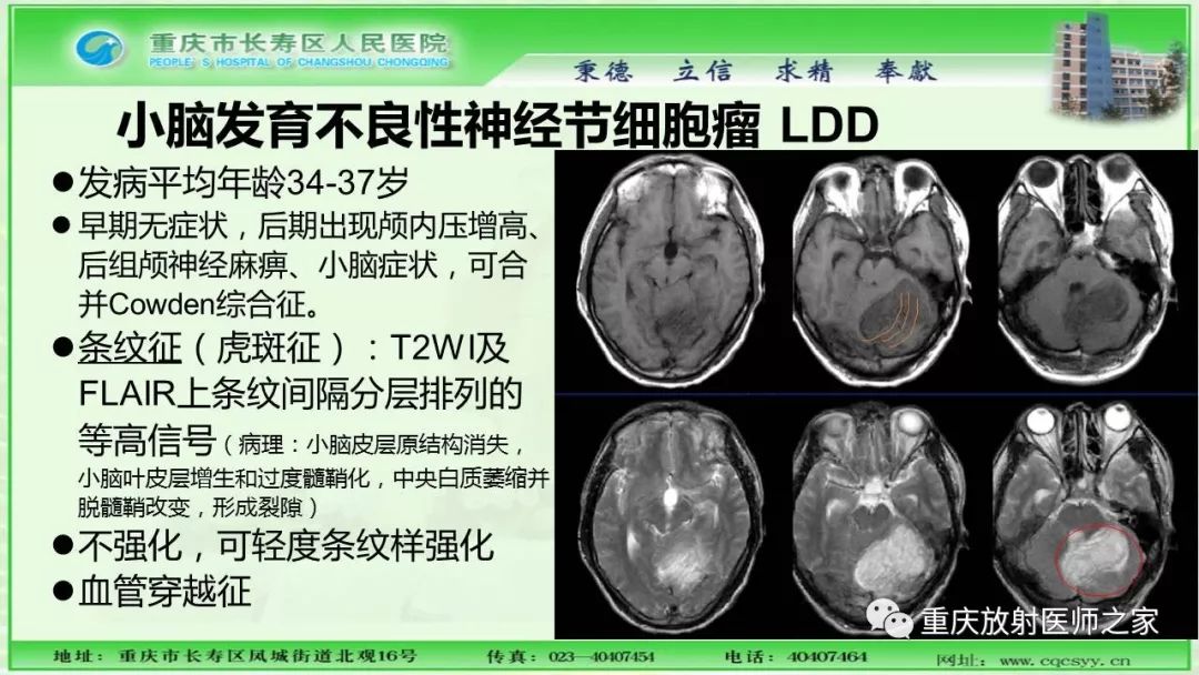 影像PPT - 【PPT】脑实质内囊性病变的MR诊断-29