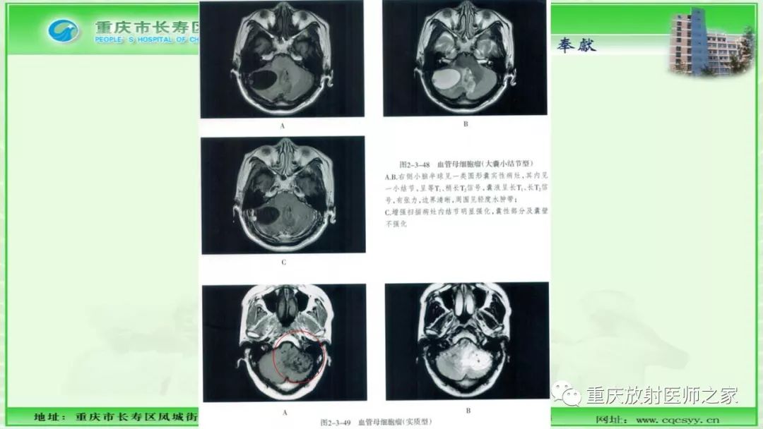 影像PPT - 【PPT】脑实质内囊性病变的MR诊断-32