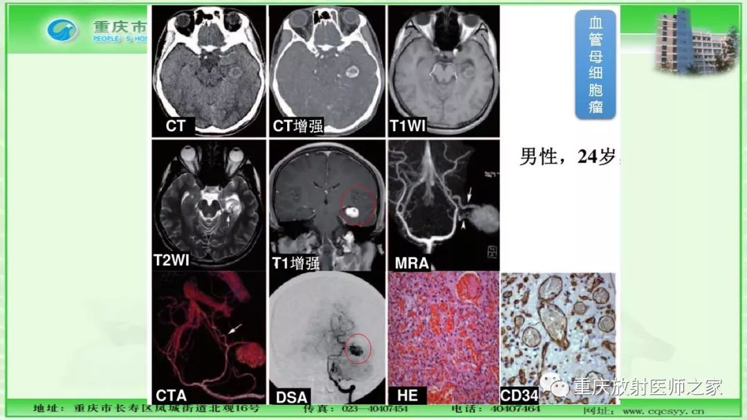 影像PPT - 【PPT】脑实质内囊性病变的MR诊断-34
