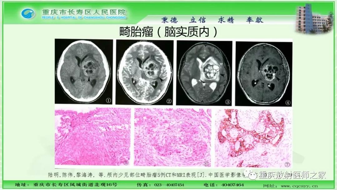 影像PPT - 【PPT】脑实质内囊性病变的MR诊断-36