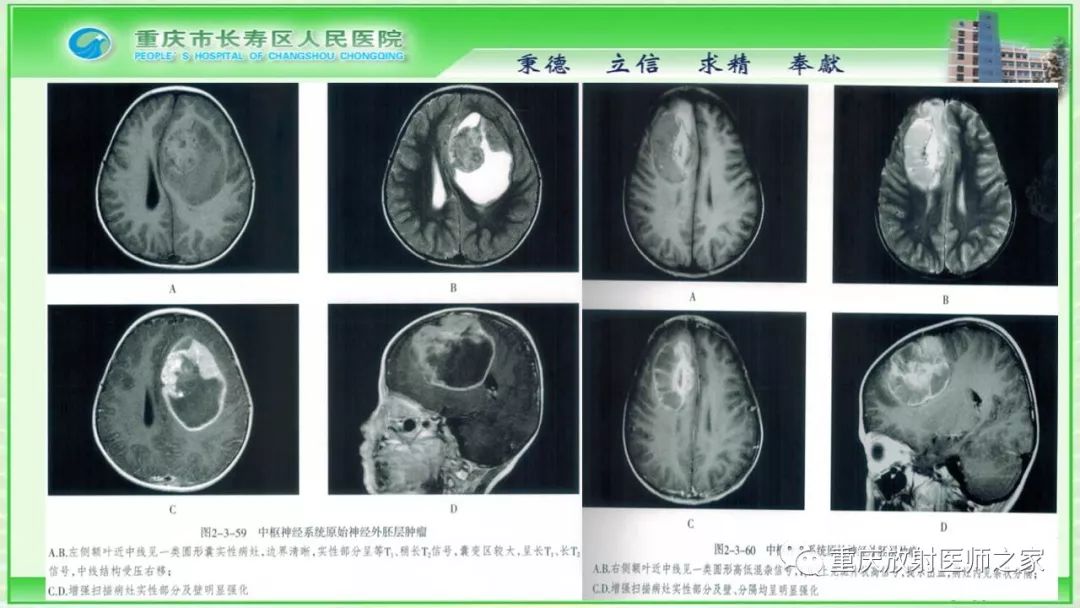 影像PPT - 【PPT】脑实质内囊性病变的MR诊断-39