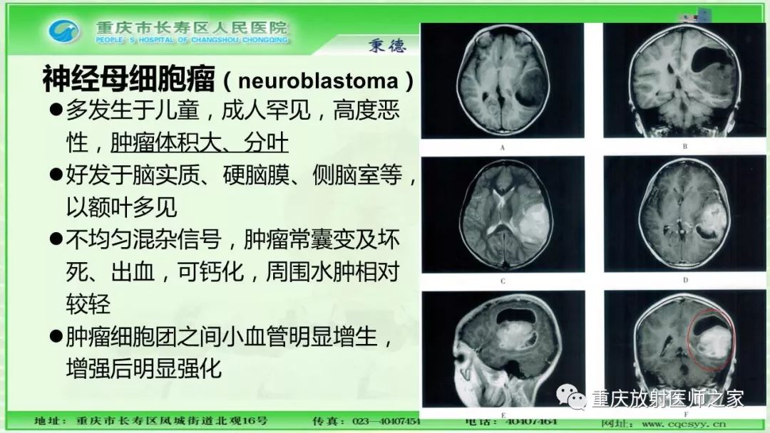 影像PPT - 【PPT】脑实质内囊性病变的MR诊断-40