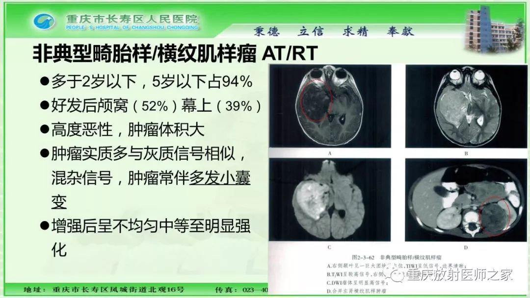 影像PPT - 【PPT】脑实质内囊性病变的MR诊断-41