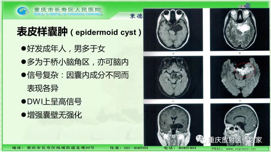 影像PPT - 【PPT】脑实质内囊性病变的MR诊断-42