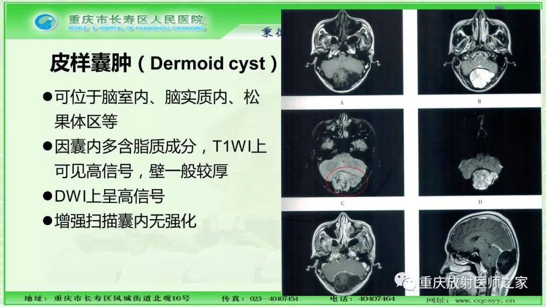 影像PPT - 【PPT】脑实质内囊性病变的MR诊断-43