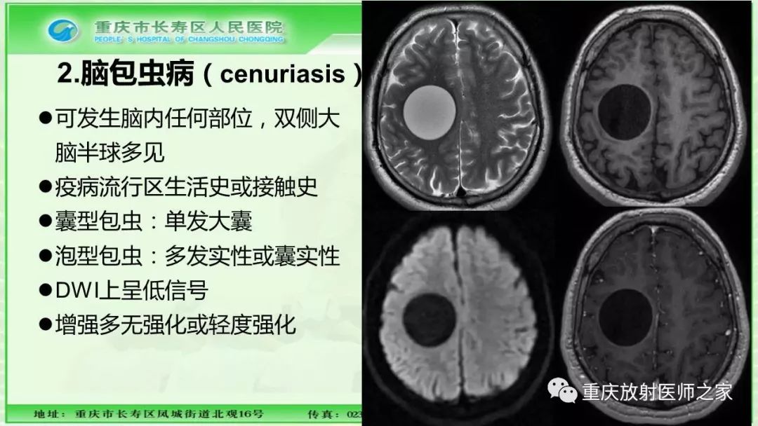 影像PPT - 【PPT】脑实质内囊性病变的MR诊断-46
