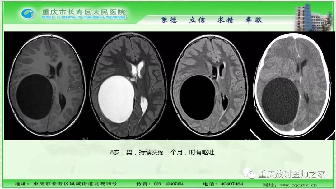影像PPT - 【PPT】脑实质内囊性病变的MR诊断-47