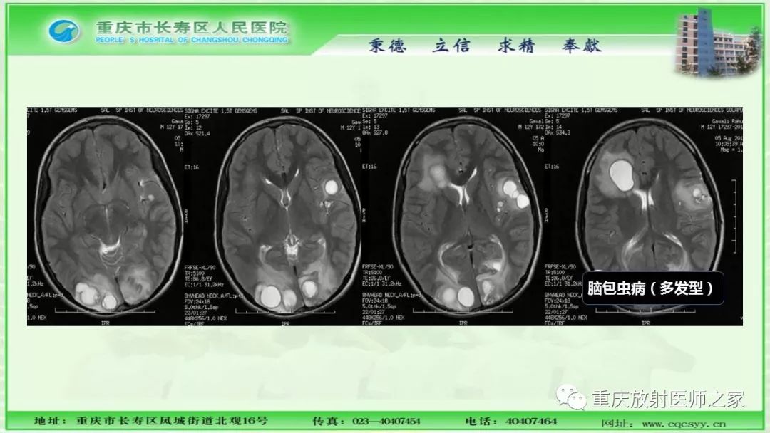 影像PPT - 【PPT】脑实质内囊性病变的MR诊断-48